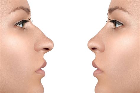 Rhinoplasty Can Fix A Crooked Nose Miami Fl