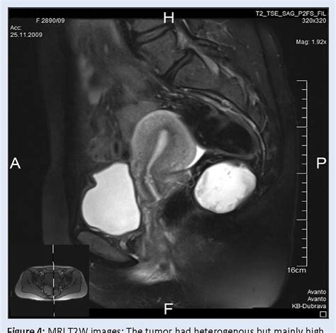 Figure 4 From Epidermoid Cyst In Presacral Space Epidermoidna Cista