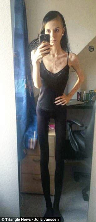 Recovering Anorexic From Zurich Hid Food In Her Ears Daily Mail Online