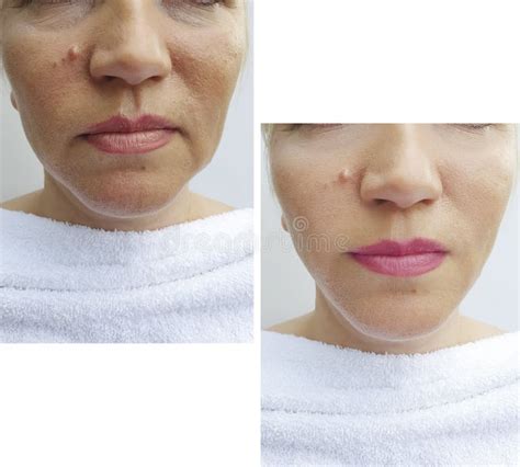 Woman Face Wrinkles Treatment Therapy Lifting Effect Before And After