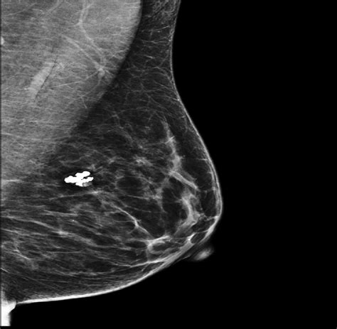 A Mammogram Of The Left Breast Showed A Left Breast Lesion With