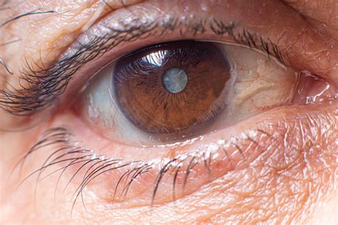 Do Cataracts Cause Blindness What Are The Causes And Risk Factors