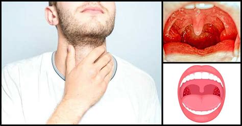 Tonsillitis Problem Check Out These Must Try Remedies Dr Farrah Md