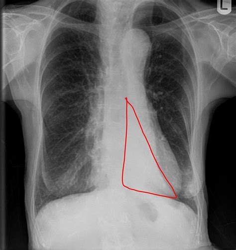 Left Lower Lobe Collapse Sail Sign Radiology Case