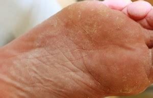 Tinea Pedis Treatment Pictures Symptoms And Causes December