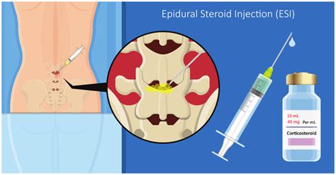 Epidural Steroid Injections Spine Info