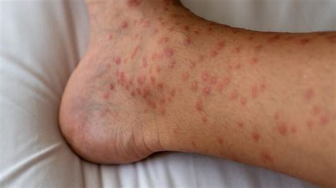 Red Spots On Skin Causes And Treatment