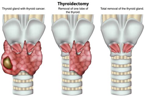 The 3 Best Thyroid Operations For Thyroid Cancer