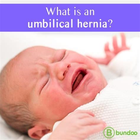 What Is An Umbilical Hernia