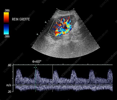 Normal Renal Ultrasound