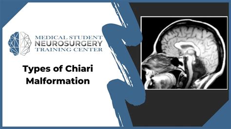 Types Of Chiari Malformation Youtube