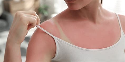 How Long Does A Sunburn Last Healthnews
