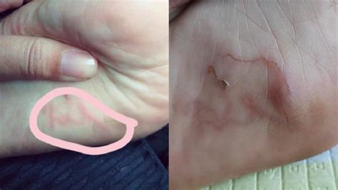 Woman Discovers A Worm In Her Foot After Not Wearing Shoes On A Port Dickson Beach
