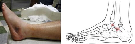 Sprained Ankle Orthoinfo Aaos