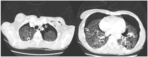 Complex Tuberous Sclerosis Associated With Pulmonary