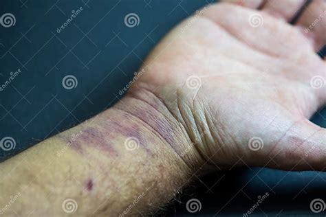 Man`s Arm With Bruises On His Hand And Wrist Stock Image Image Of