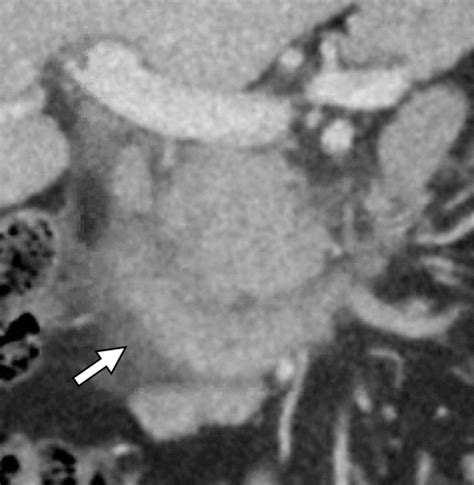 Imaging Spectrum Of Duodenal Emergencies Radiographics