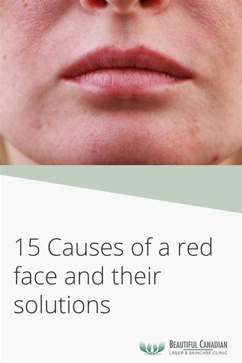 15 Causes Of A Red Face And Their Solutions Skin Care Centre Surrey