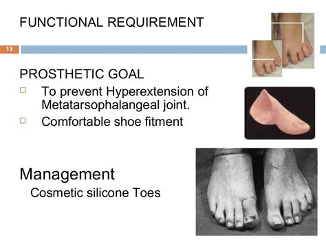 Prosthetic Management Of Symes And Partial Foot Amputation