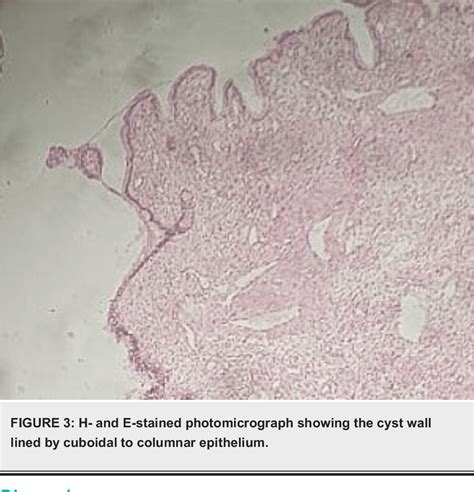 Figure 3 From A Rare Case Of Posterior Vaginal Wall Gartner S Duct Cyst