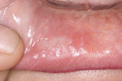 Aphthous Ulcer In The Mouth Stock Image C Science Photo