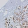 Benign adenomatoid mesothelioma pathology outlines. Pathology Outlines - Calretinin