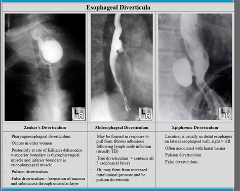 Esophageal Diverticula Diagnostic Imaging Radiology Medical Mnemonics