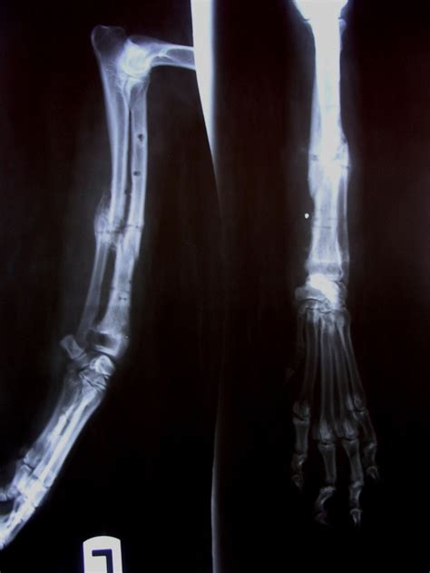 Trattamento di una frattura diafisaria di radio-ulna