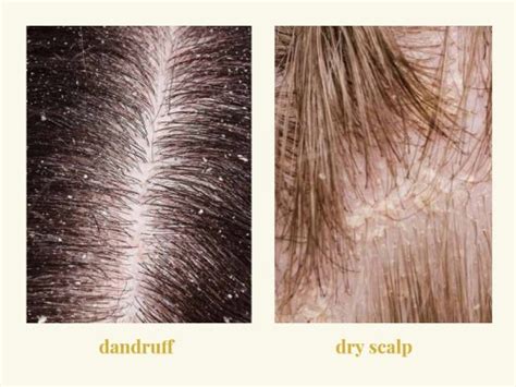 Dandruff Vs Dry Scalp Causes Symptoms And Best Treatments