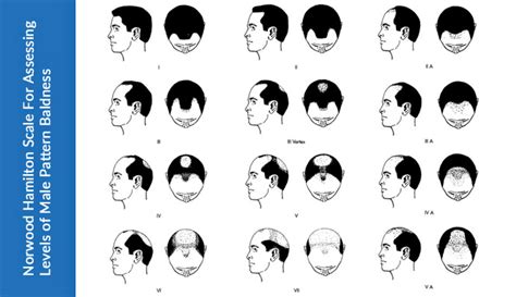 Baldness The Early Signs And Prevention