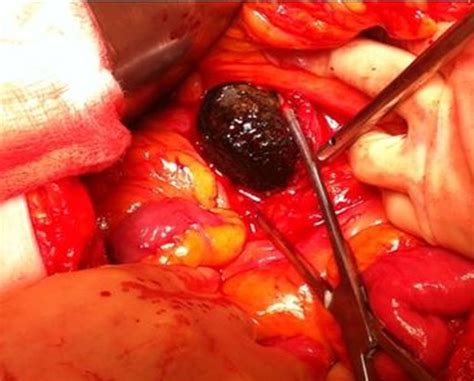 Giant Gallstone In The Duodenum Bmj Case Reports