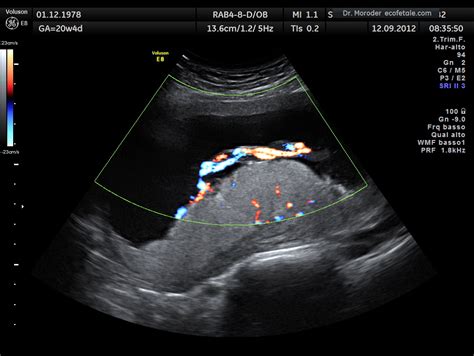 Filehuman Placenta Umbilical Cord Ultrasound By Dr W Moroder