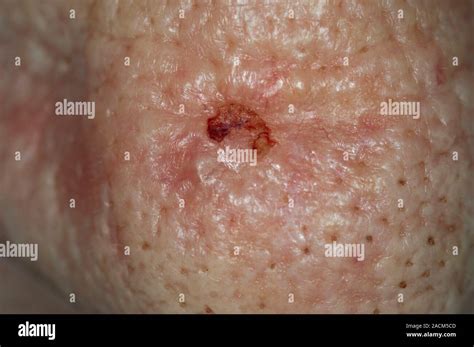 Close Up Of Basal Cell Carcinoma Bcc Or Rodent Ulcer On The Nose In