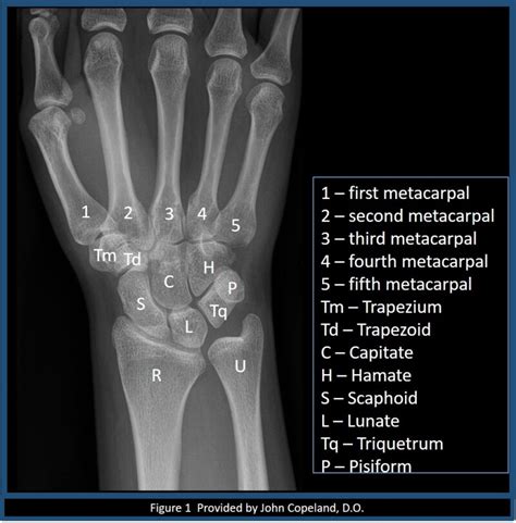 Figure Wrist X Ray With Labeled Osseous Anatomy Contributed By John
