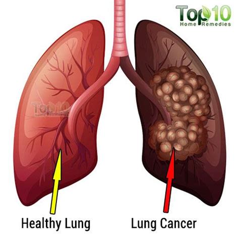 We'd also like to use analytics cookies. 10 Signs and Symptoms of Lung Cancer You Should Not Ignore ...