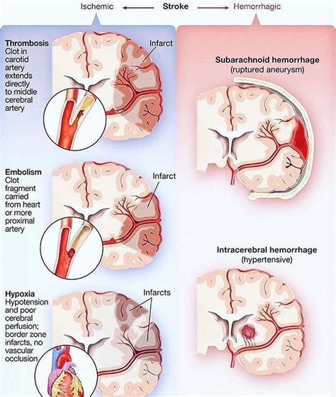 Doctordconline “different Types Of Brain Stroke Ischemic And Hemorrhage Brain Stroke