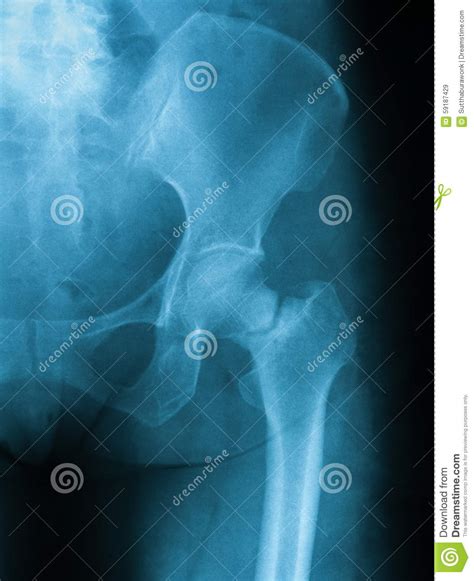 X Ray Of A Femoral Neck Fracture Hip Fracture Due To Multiple Myeloma