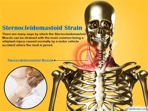 Sternocleidomastoid Straincausessymptomstreatmentexercise