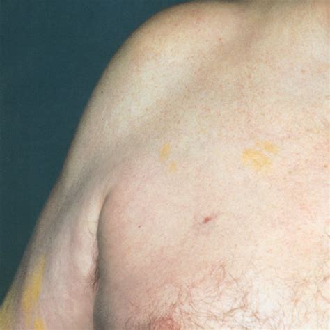 Patients Right Arm Showing Patchy Yellow Discoloration Of The Skin