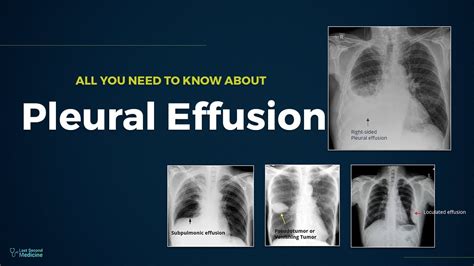 Pleural Effusion Types Causes Evaluation And Management All You Need
