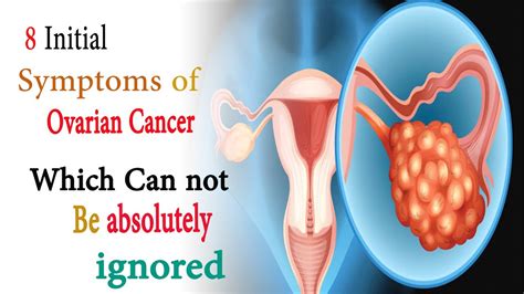 What Are Ovarian Cancer Symptoms Causes Diagnosis Treatment