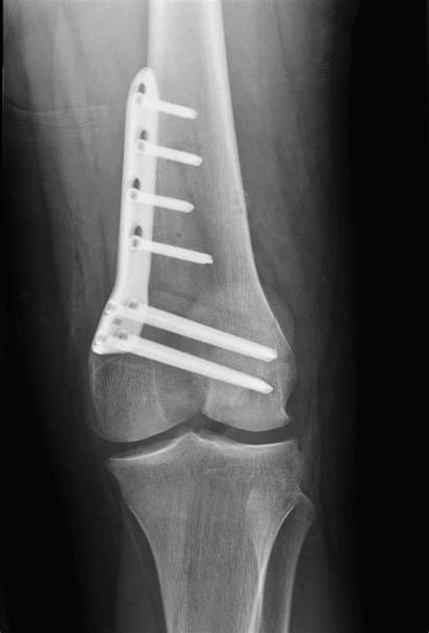 Distal Femoral Osteotomy For The Valgus Knee Medial Closing Wedge
