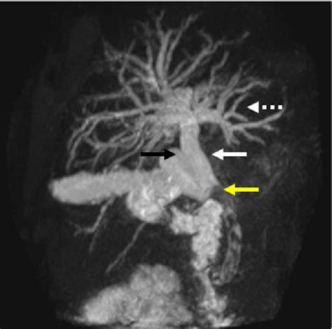Mrcp Shows Marked Dilatation Of Intrahepatic White­dashed Arrow And