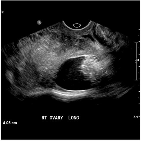 Ovarian Torsion With Dermoid Cyst Image