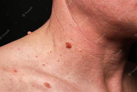 Birthmark Removal Before And After A Comprehensive Guide Itechment