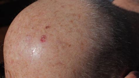 Skin Cancer On Scalp Symptoms Diagnosis Treatment And Prevention
