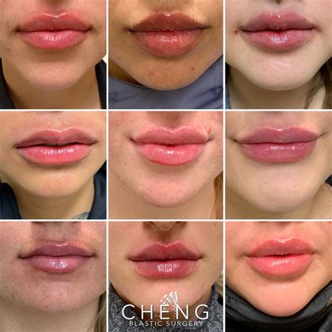cupid s bow lip filler before and after before and after