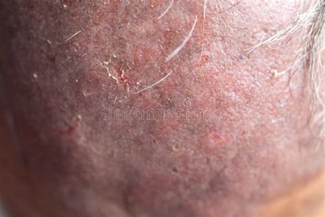 A Physical Of Atopic Dermatitis Ad Also Known As Atopic Eczema Stock