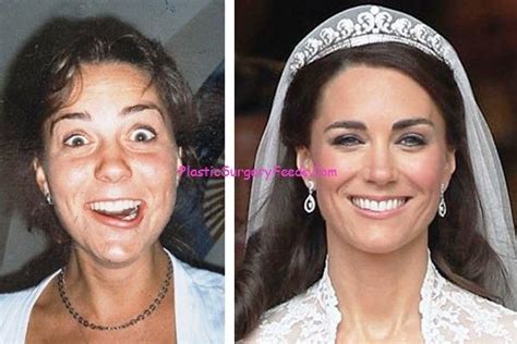 Kate Middleton Plastic Surgery Before And After Photo Of Eyes And