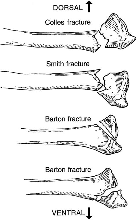 Distal Radius Fracture Types
